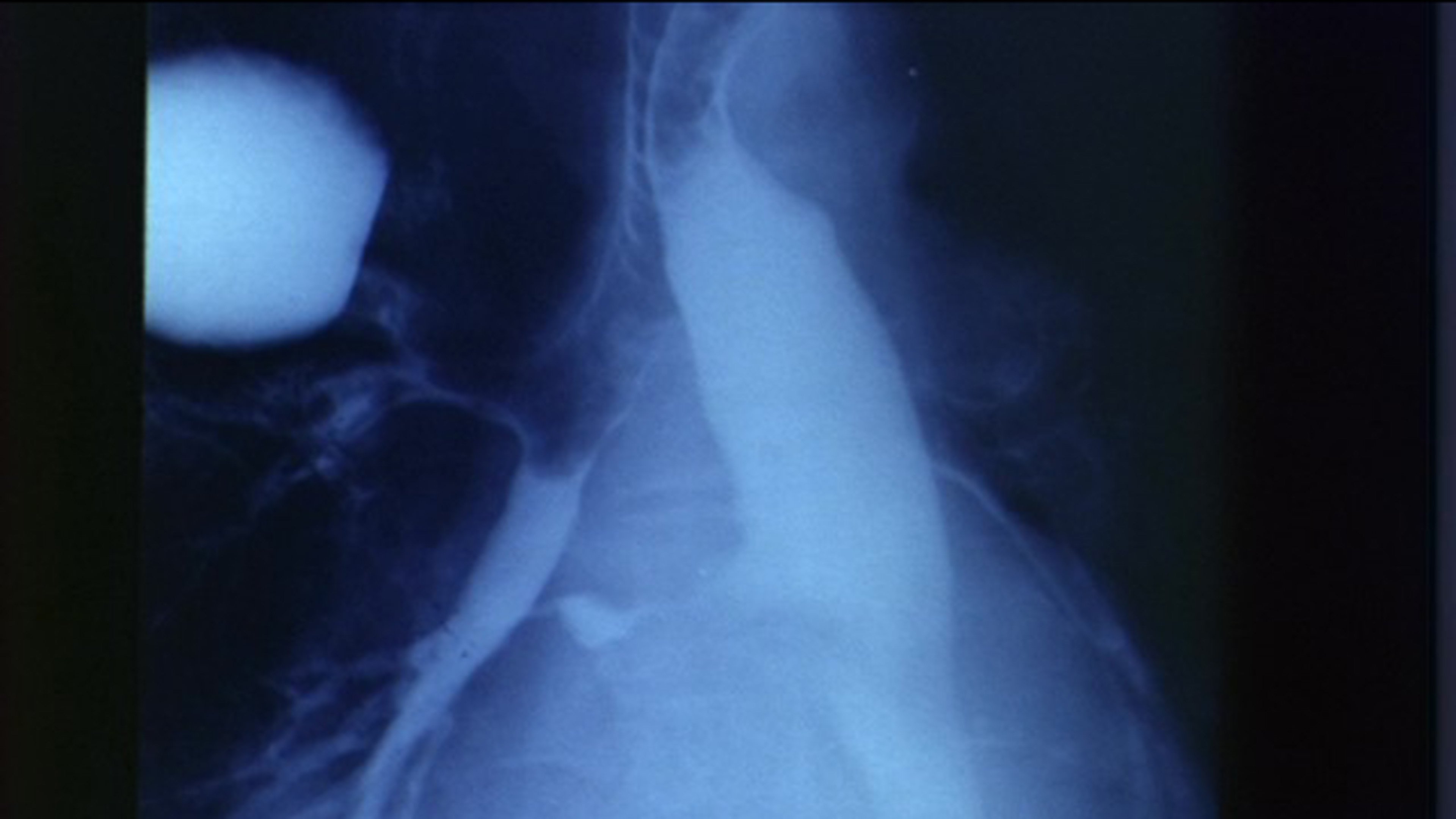 Congenital Broncho-oesophageal Fistula in an Adult
