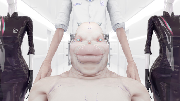 Caterpillarplasty