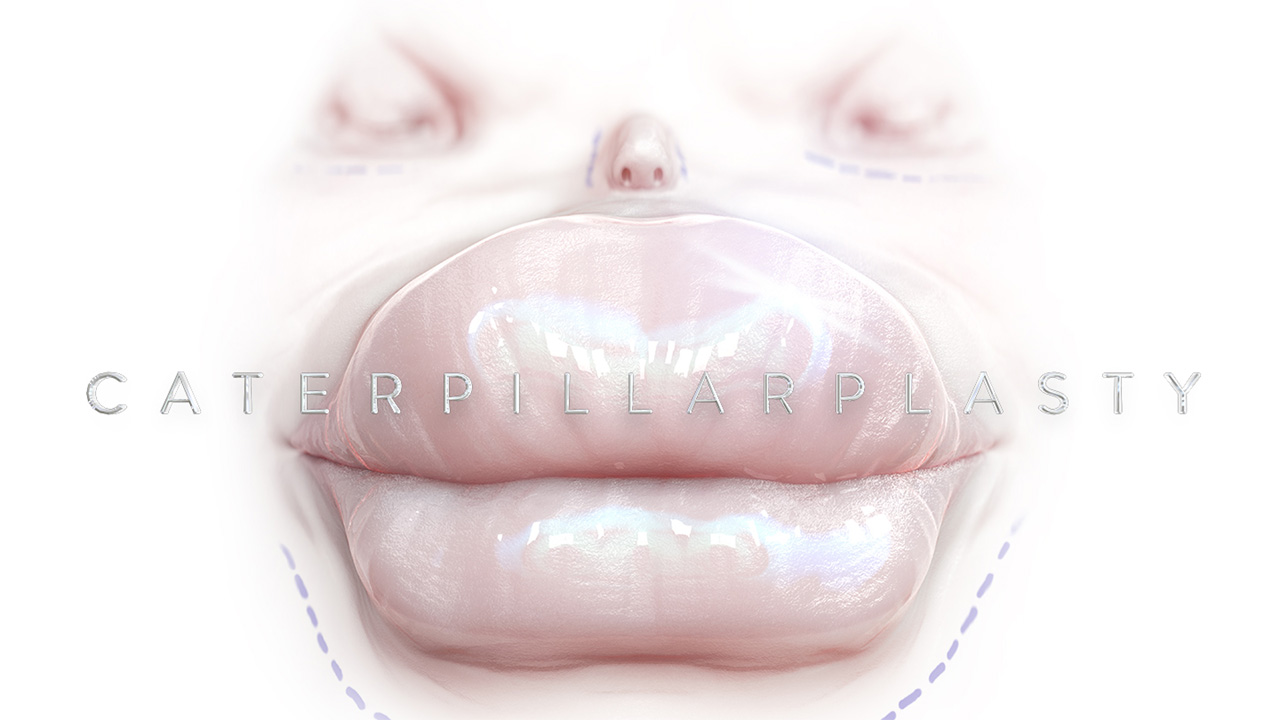 Caterpillarplasty